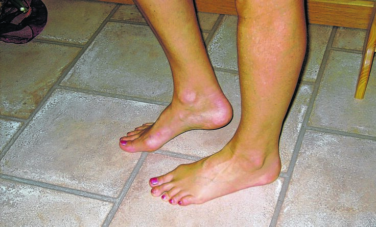 Das „Restless-legs“-Syndrom belastet die Betroffenen oft schwer.