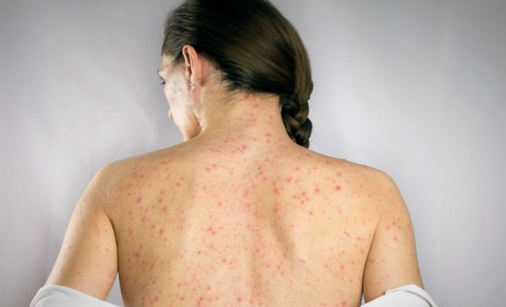 Masern sind durch Impfmüdigkeit wieder im Vormarsch. Foto: OneSideProFoto/Shutterstock.com