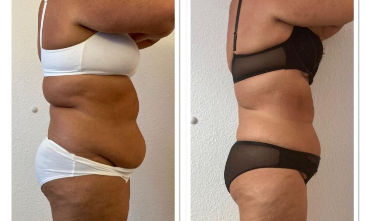 Vor (l.) und das Ergebnis nach zehn „Abnehmen im Liegen“-Behandlungen (Foto: Steinkellner)