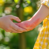 Wenn der Stich zur Gefahr wird: Was Eltern über Insektengift-Allergien bei Kindern wissen sollten